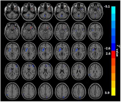 Altered Spontaneous Brain Activity in Betel Quid Dependence Chewers: A Resting-State Functional MRI Study With Percent Amplitude of Fluctuation